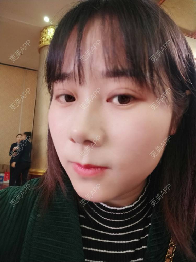 更美 - 更美用户2xnQj47lDg的眼部综合经验 | 眼部综合 | 重庆