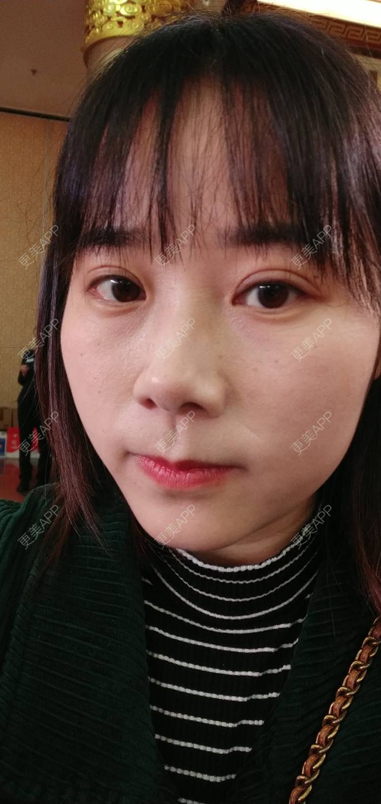 更美 - 更美用户2xnQj47lDg的眼部综合经验 | 眼部综合 | 重庆