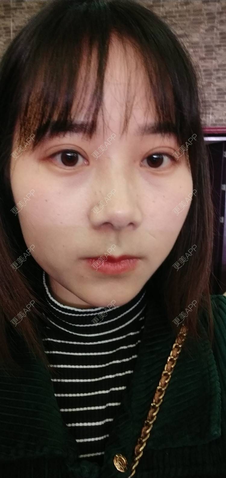 更美 - 更美用户2xnQj47lDg的眼部综合经验 | 眼部综合 | 重庆