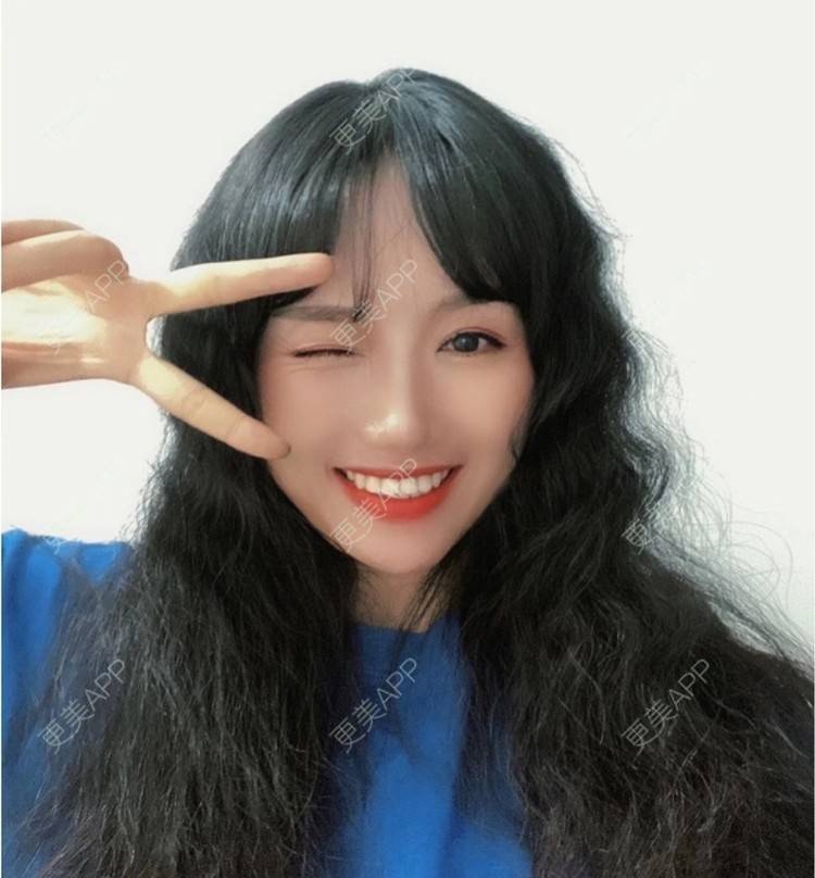 更美 - 努力变美123123的除皱瘦脸经验 | 除皱瘦脸 | 苏州