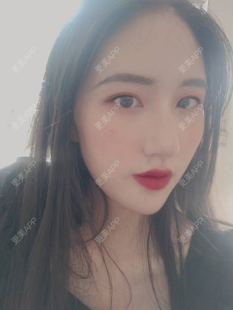 更美 - 幾忿揂噫濃的鼻中隔软骨隆鼻经验 | 成都 | 视频日记 | 鼻中隔软骨隆鼻