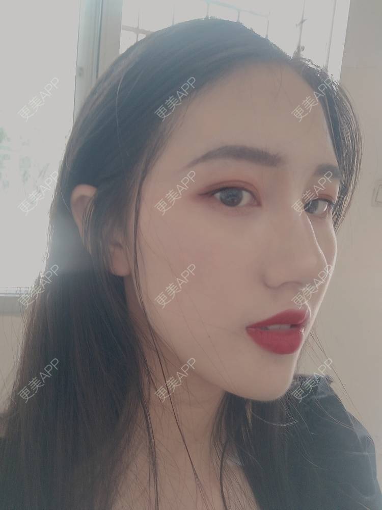 更美 - 幾忿揂噫濃的鼻中隔软骨隆鼻经验 | 成都 | 视频日记 | 鼻中隔软骨隆鼻