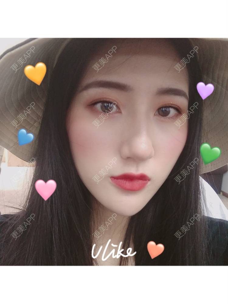 更美 - 幾忿揂噫濃的鼻中隔软骨隆鼻经验 | 成都 | 视频日记 | 鼻中隔软骨隆鼻