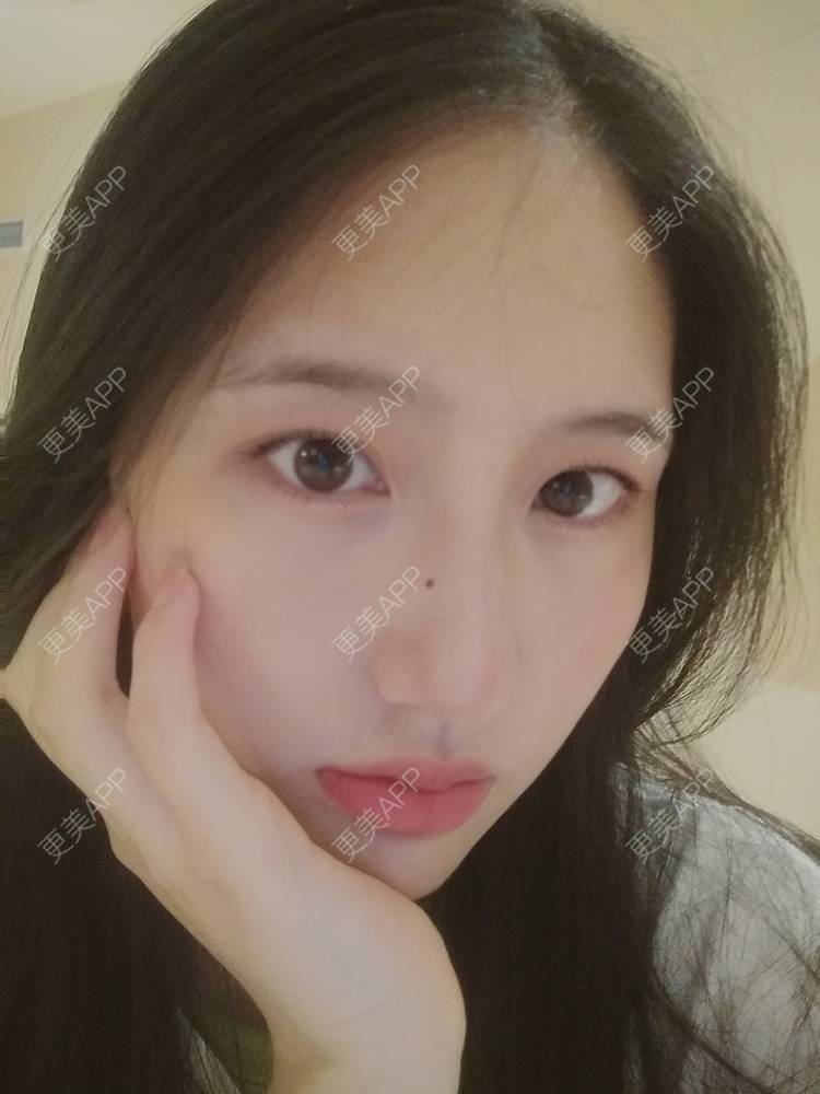 更美 - 幾忿揂噫濃的鼻中隔软骨隆鼻经验 | 成都 | 视频日记 | 鼻中隔软骨隆鼻