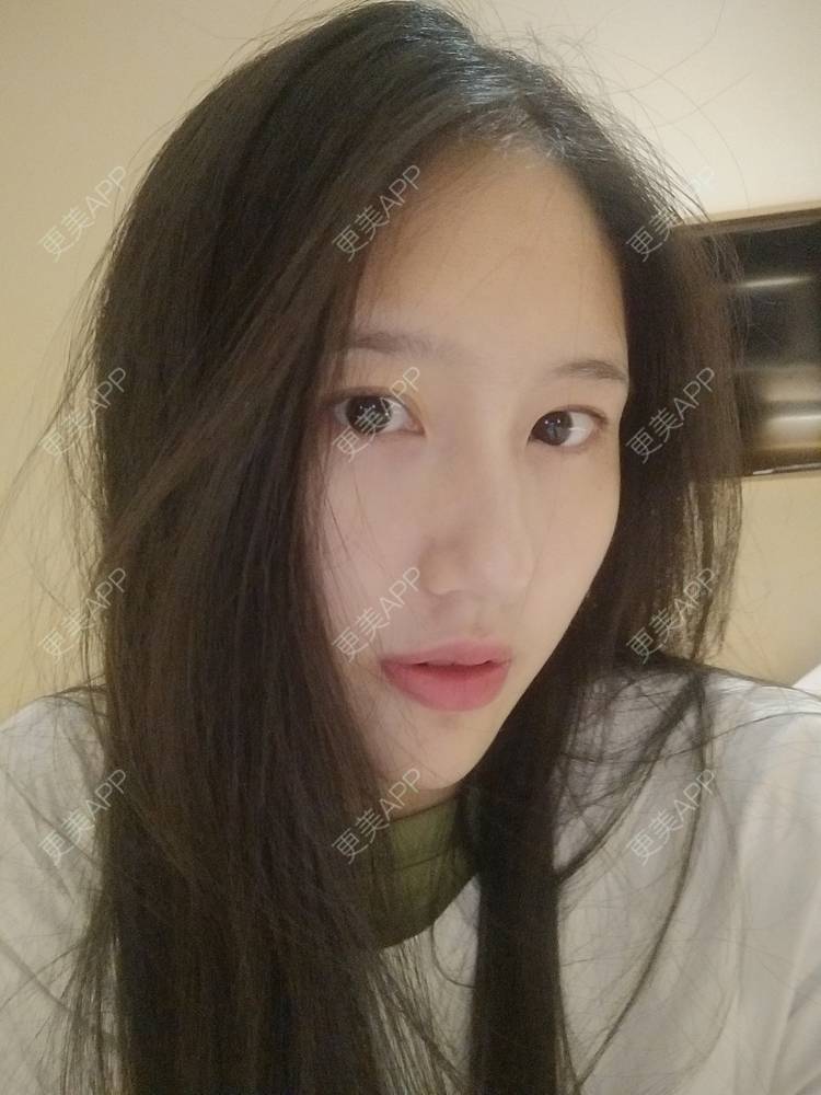 更美 - 幾忿揂噫濃的鼻中隔软骨隆鼻经验 | 成都 | 视频日记 | 鼻中隔软骨隆鼻