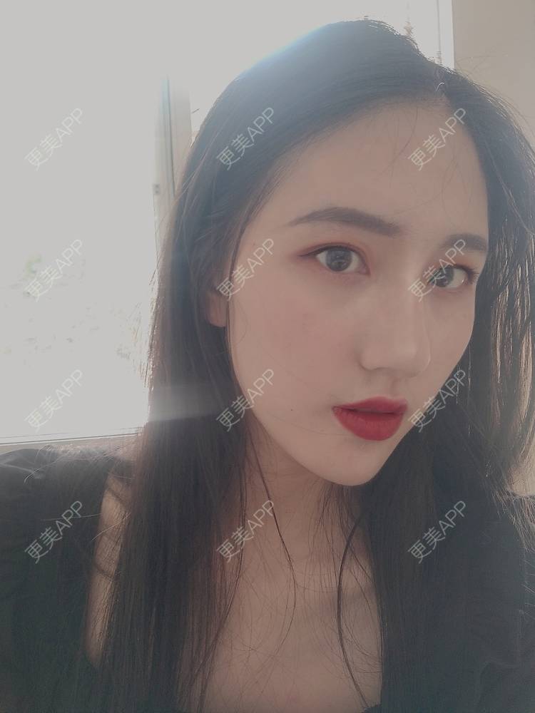 更美 - 幾忿揂噫濃的鼻中隔软骨隆鼻经验 | 成都 | 视频日记 | 鼻中隔软骨隆鼻