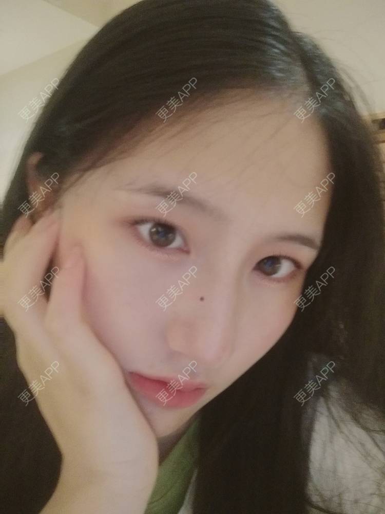 更美 - 幾忿揂噫濃的鼻中隔软骨隆鼻经验 | 成都 | 视频日记 | 鼻中隔软骨隆鼻