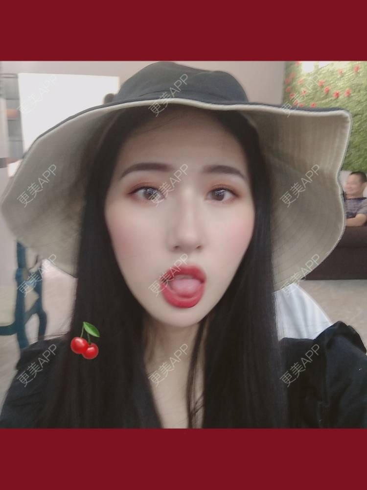 更美 - 幾忿揂噫濃的鼻中隔软骨隆鼻经验 | 成都 | 视频日记 | 鼻中隔软骨隆鼻