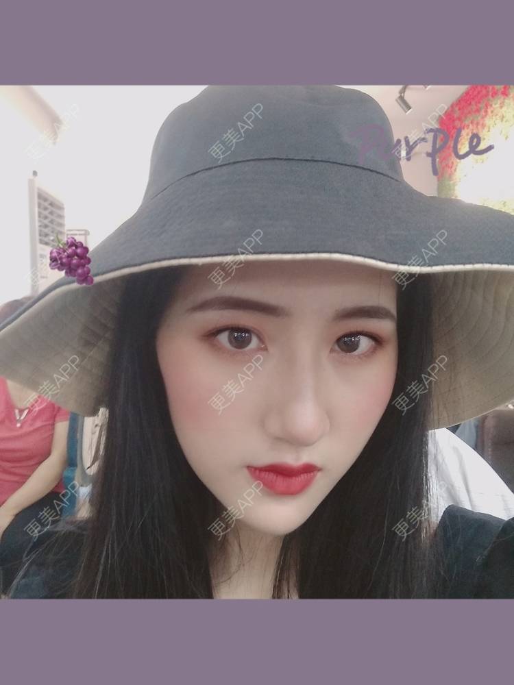 更美 - 幾忿揂噫濃的鼻中隔软骨隆鼻经验 | 成都 | 视频日记 | 鼻中隔软骨隆鼻