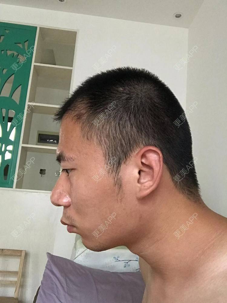 双鬓角植发(鬓角植发一般需要多少根毛发)
