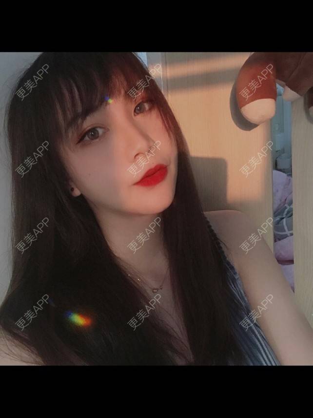 更美 - 更美用户hpUUyPQazb的上下颚手术经验 | 上海 | 上下颚手术