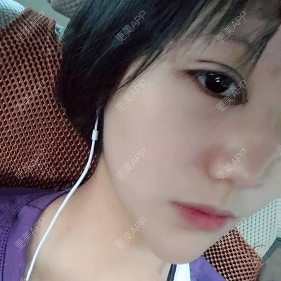 更美 - 更美用户QhVYqz6e5S的双眼皮经验 | 上海 | 双眼皮