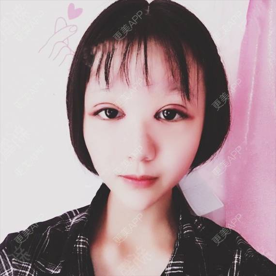 更美 - 更美用户QhVYqz6e5S的双眼皮经验 | 上海 | 双眼皮