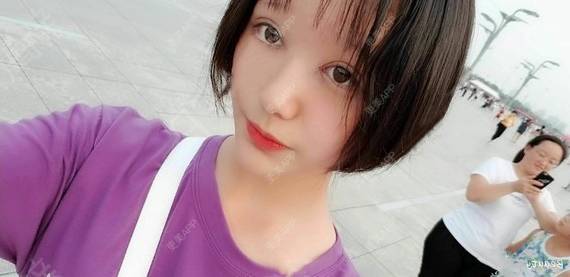 更美 - 更美用户QhVYqz6e5S的双眼皮经验 | 上海 | 双眼皮