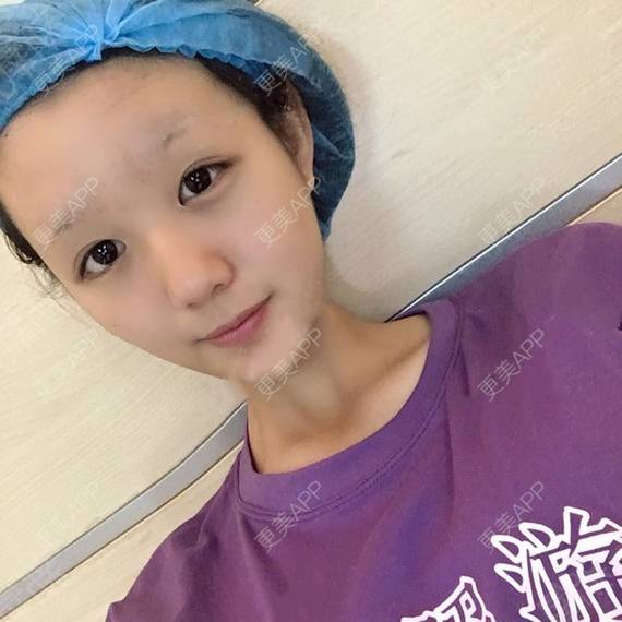 更美 - 更美用户QhVYqz6e5S的双眼皮经验 | 上海 | 双眼皮