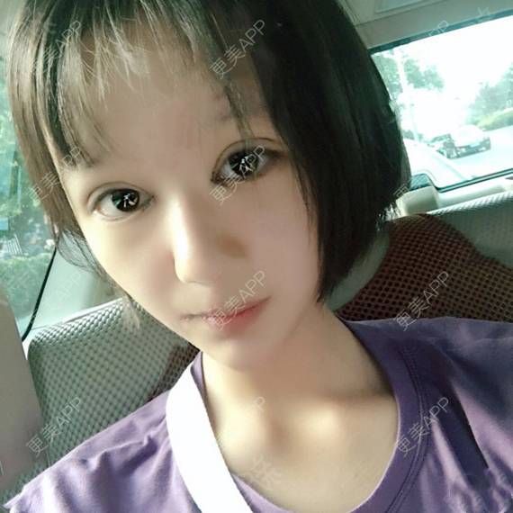 更美 - 更美用户QhVYqz6e5S的双眼皮经验 | 上海 | 双眼皮