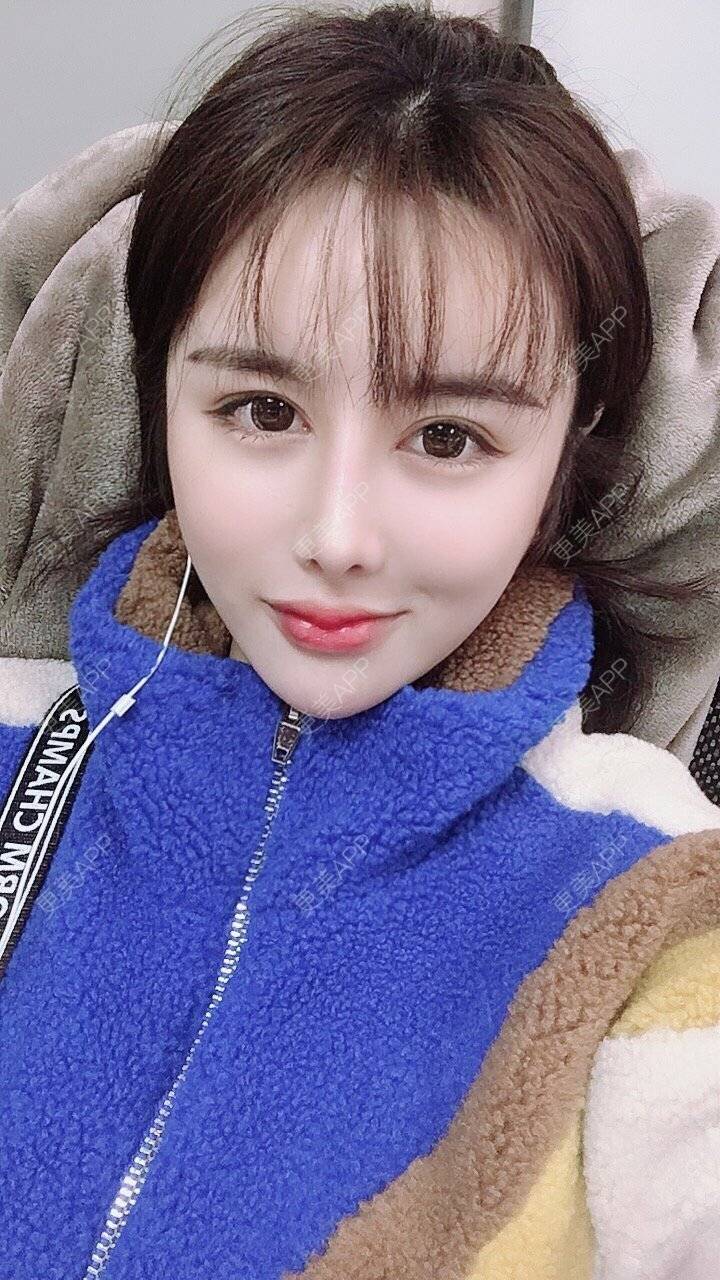 更美 - 巧巧太碎了的鼻部多项经验 | 视频日记 | 重庆 | 硅胶隆鼻 | 肋软骨隆鼻 | 鼻部多项 | 鼻翼缩小