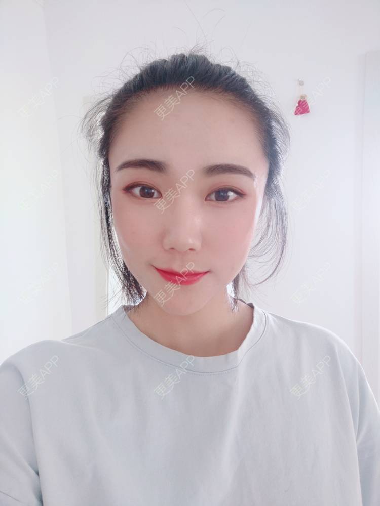 更美 - 更美魔女的埋线提升经验 | 埋线提升 | 郑州 | 埋线除皱