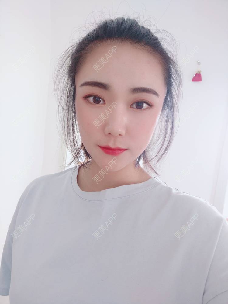 更美 - 更美魔女的埋线提升经验 | 埋线提升 | 郑州 | 埋线除皱