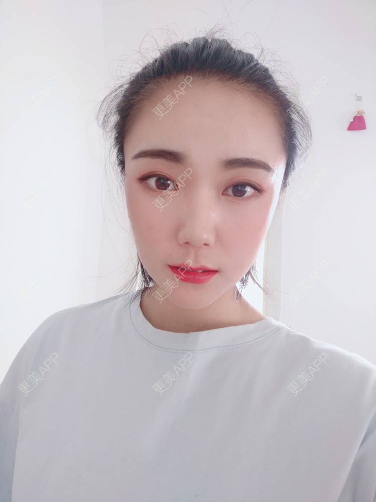 更美 - 更美魔女的埋线提升经验 | 埋线提升 | 郑州 | 埋线除皱