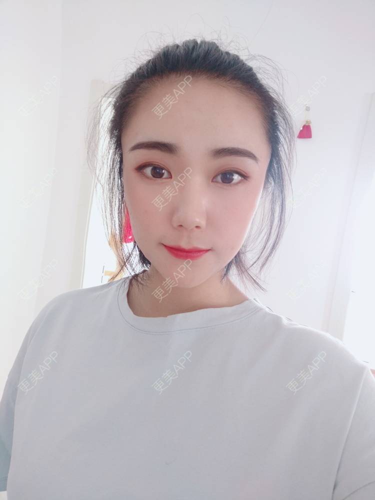 更美 - 更美魔女的埋线提升经验 | 埋线提升 | 郑州 | 埋线除皱