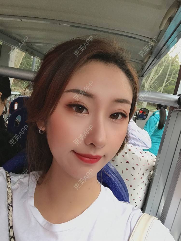 更美 - Gonve1的颧骨内推经验 | 广州 | 颧骨内推