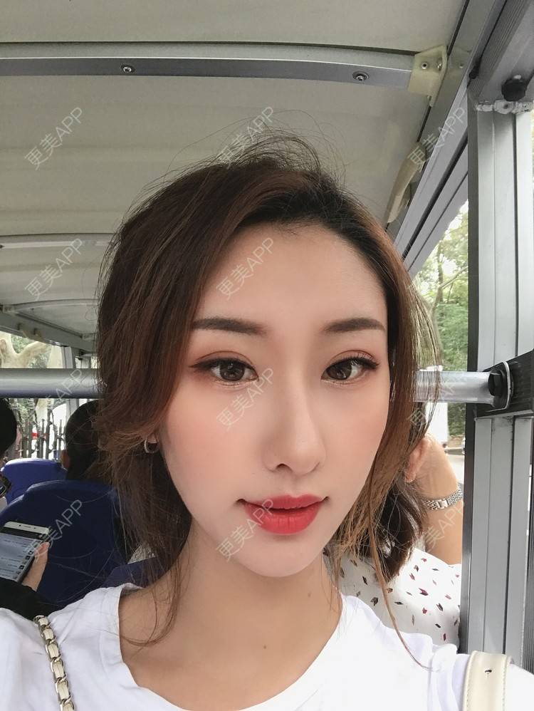 更美 - Gonve1的颧骨内推经验 | 广州 | 颧骨内推