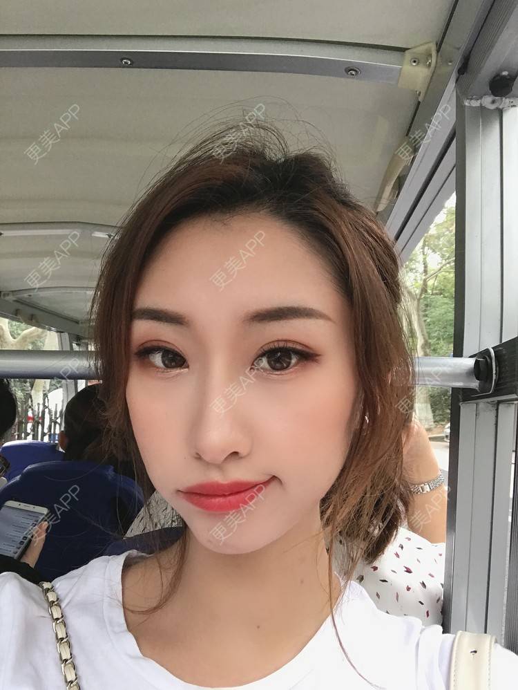 更美 - Gonve1的颧骨内推经验 | 广州 | 颧骨内推