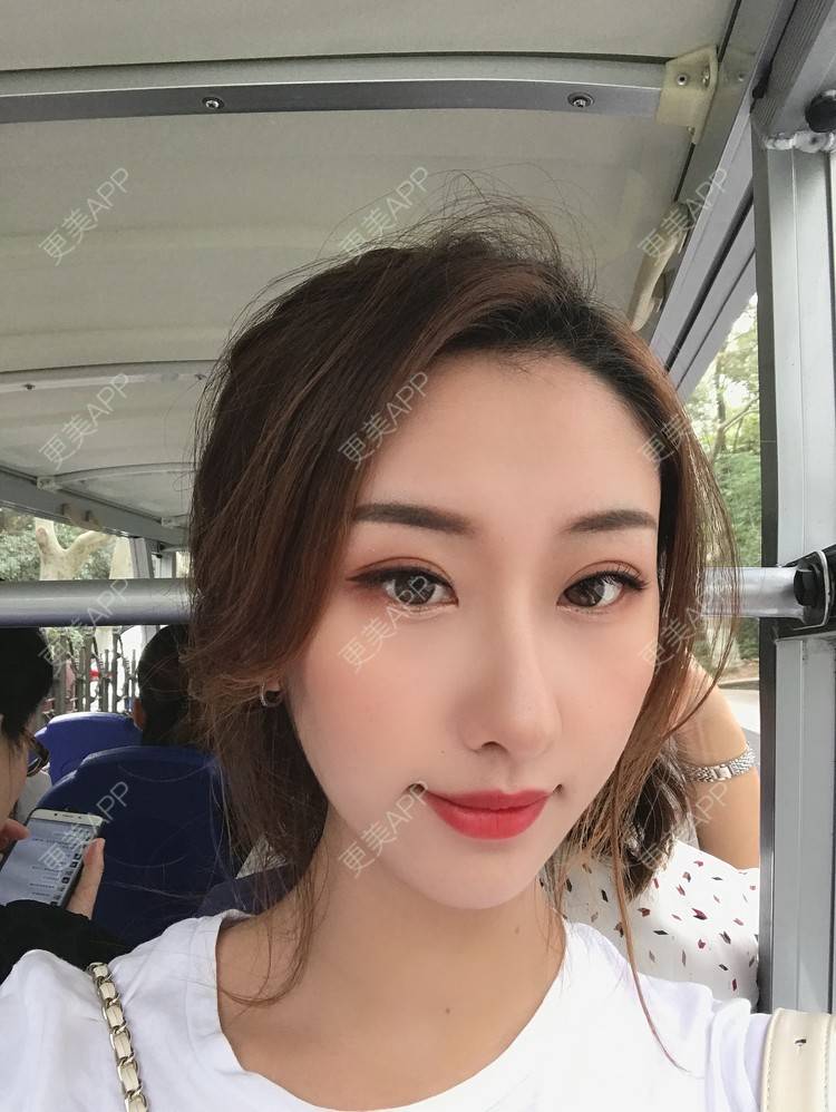 更美 - Gonve1的颧骨内推经验 | 广州 | 颧骨内推