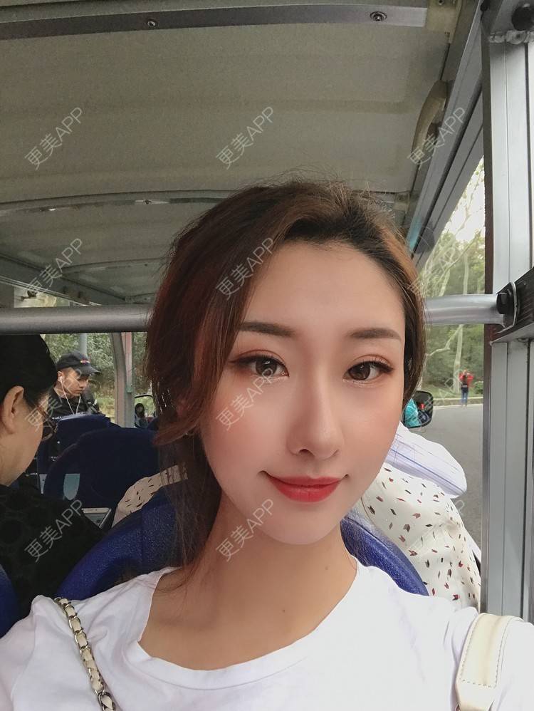 更美 - Gonve1的颧骨内推经验 | 广州 | 颧骨内推