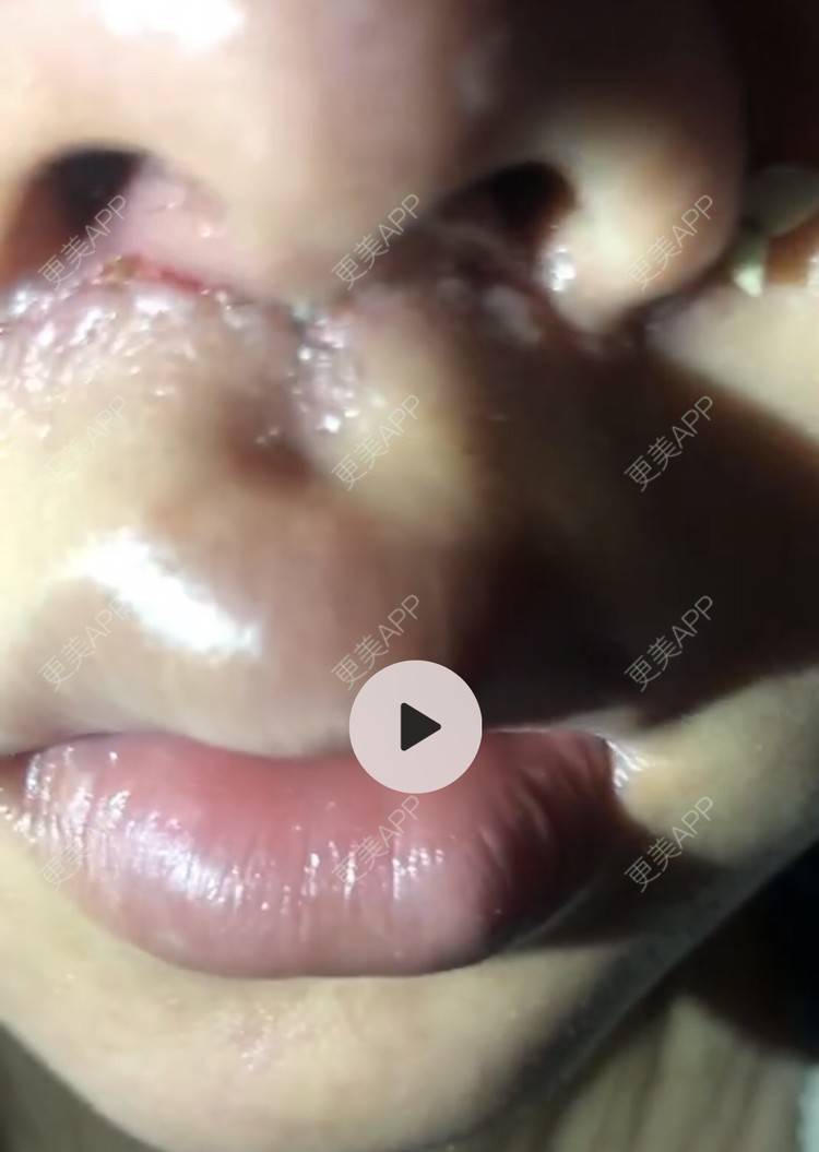 錵样年华的唇腭裂修复日记