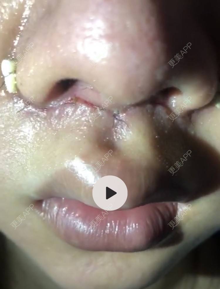 錵样年华的唇腭裂修复日记