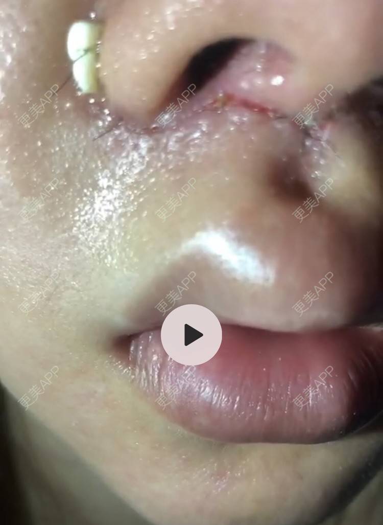 錵样年华的唇腭裂修复日记