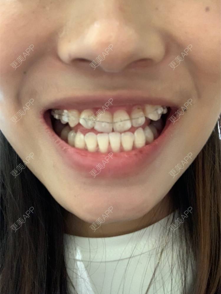 更美 - 听说°&的牙齿矫正经验 | 北京 | 金属托槽矫正