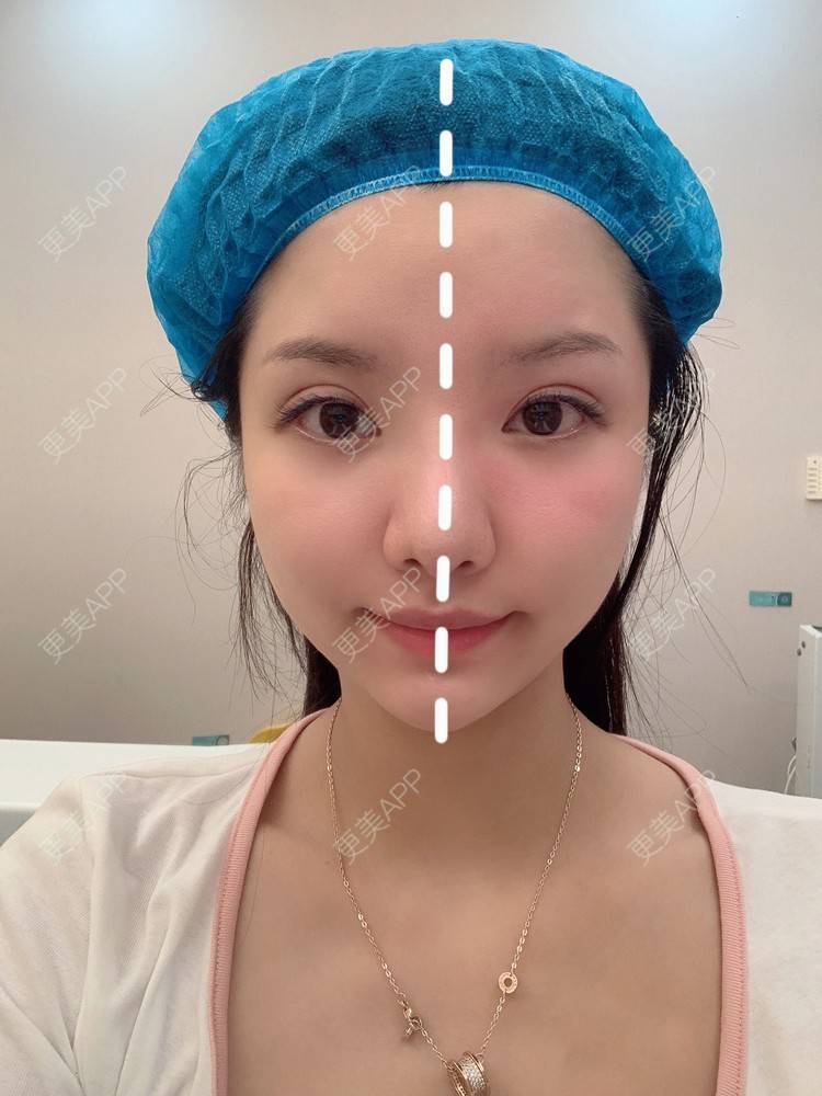 更美 - 更美用户9ZoYKnm4jW的激光淡化黑眼圈经验 | 激光淡化黑眼圈 | 深圳