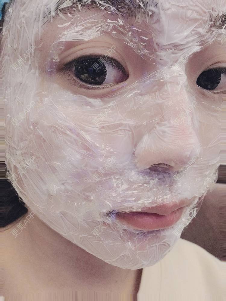 更美 - a＂兔💌☃的射频提升经验 | 武汉 | 射频提升