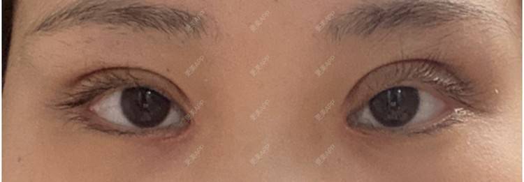 更美 - if you if的开内眼角经验 | 上海 | 眼部多项