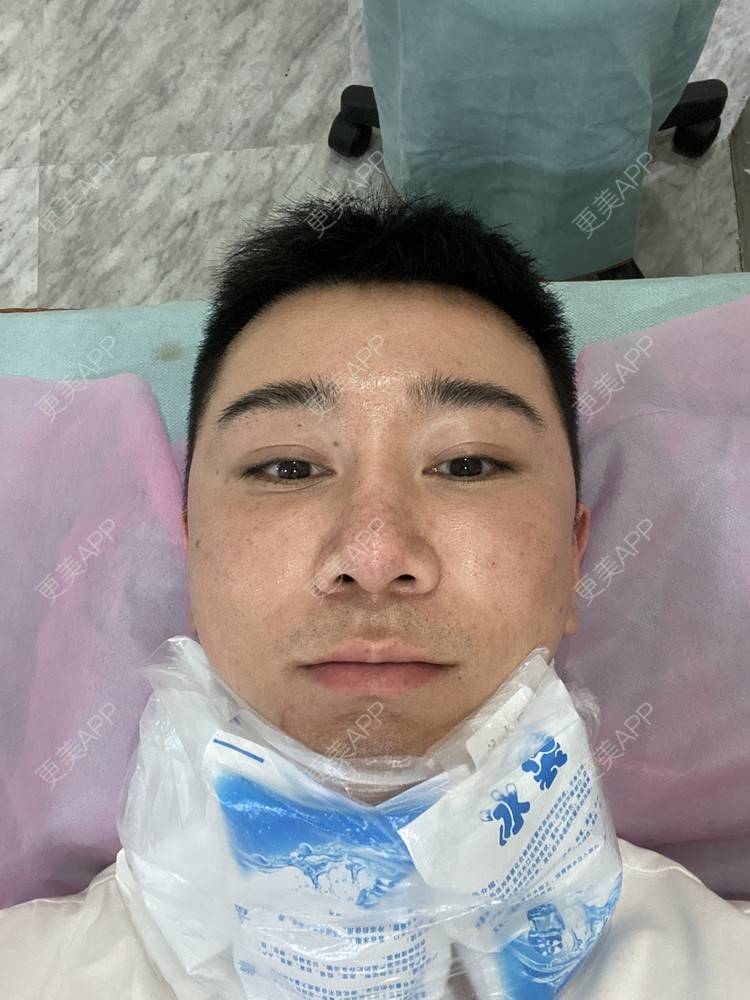 更美 - Es小喵的埋线提升经验 | 埋线提升 | 埋线除皱 | 广州