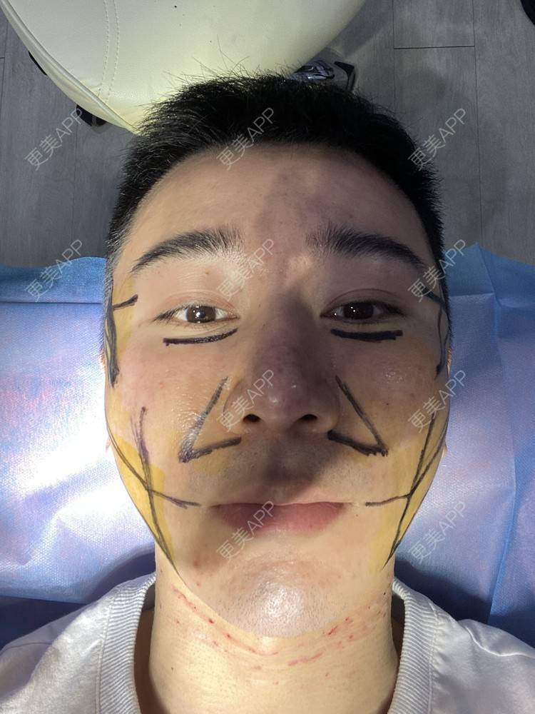 更美 - Es小喵的埋线提升经验 | 埋线提升 | 埋线除皱 | 广州