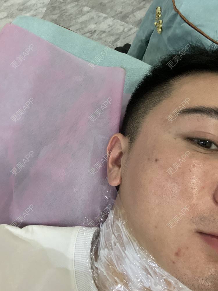 更美 - Es小喵的埋线提升经验 | 埋线提升 | 埋线除皱 | 广州