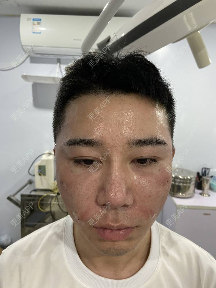 更美 - Es小喵的埋线提升经验 | 埋线提升 | 埋线除皱 | 广州