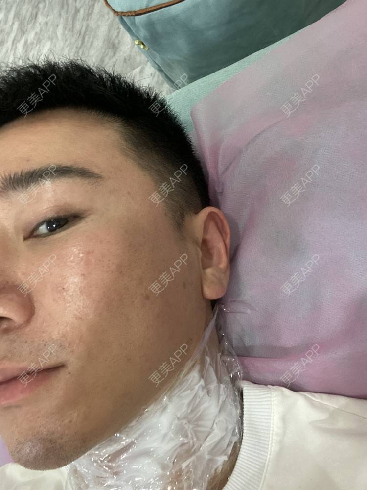 更美 - Es小喵的埋线提升经验 | 埋线提升 | 埋线除皱 | 广州