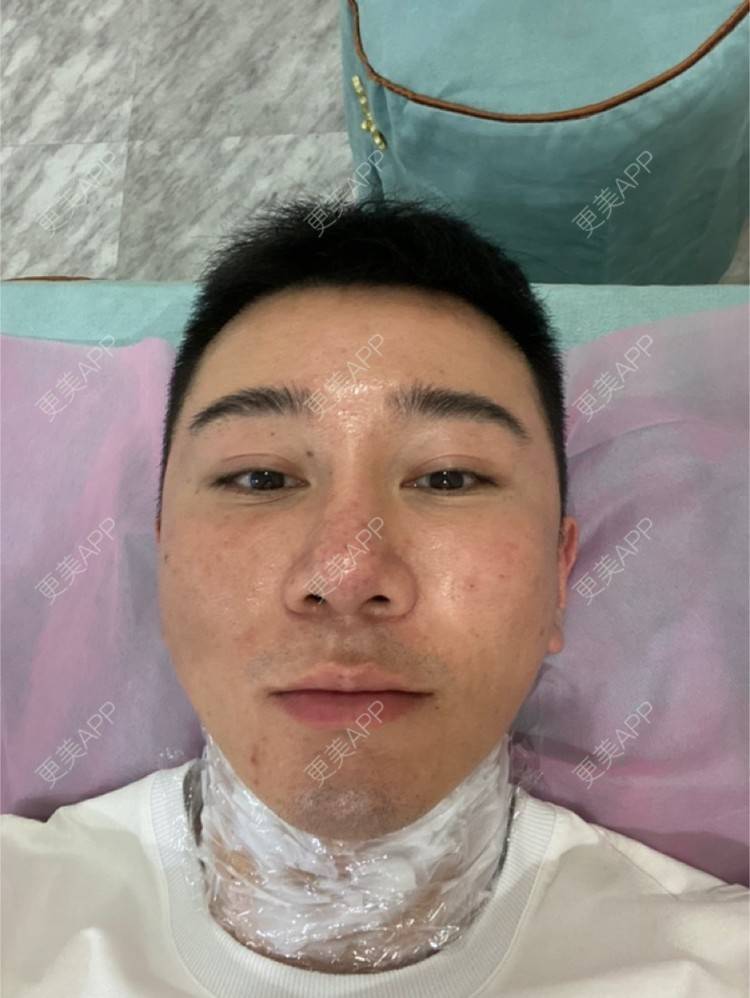 更美 - Es小喵的埋线提升经验 | 广州 | 埋线提升