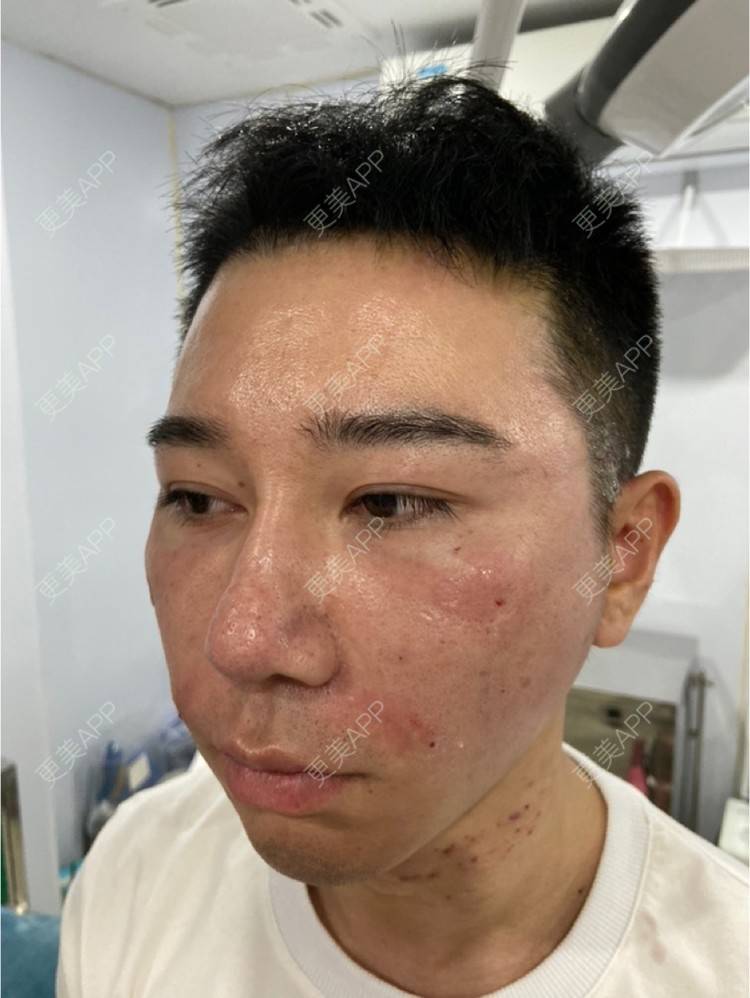 更美 - Es小喵的埋线提升经验 | 广州 | 埋线提升