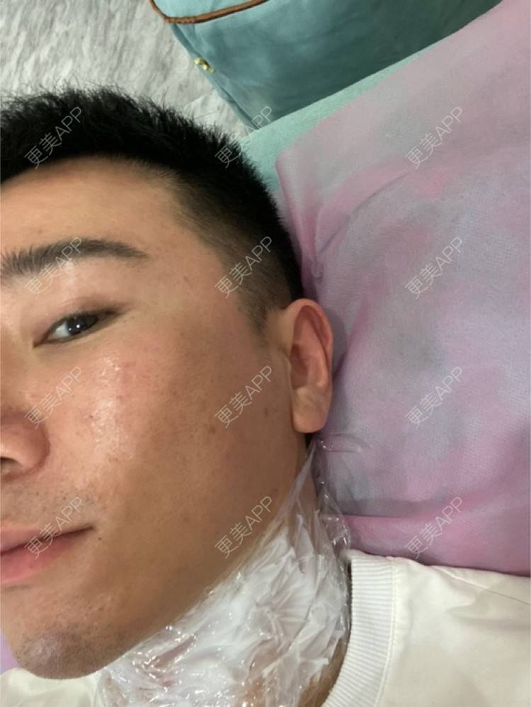 更美 - Es小喵的埋线提升经验 | 广州 | 埋线提升