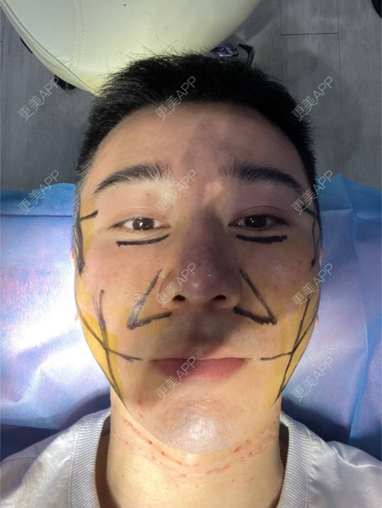 更美 - Es小喵的埋线提升经验 | 广州 | 埋线提升