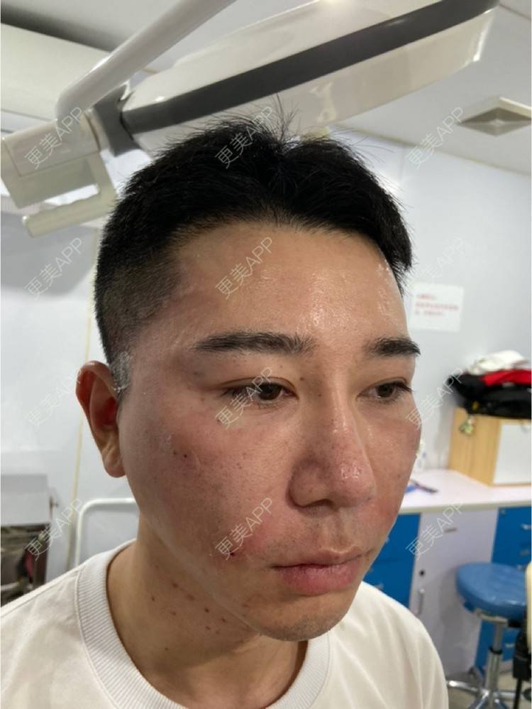 更美 - Es小喵的埋线提升经验 | 广州 | 埋线提升