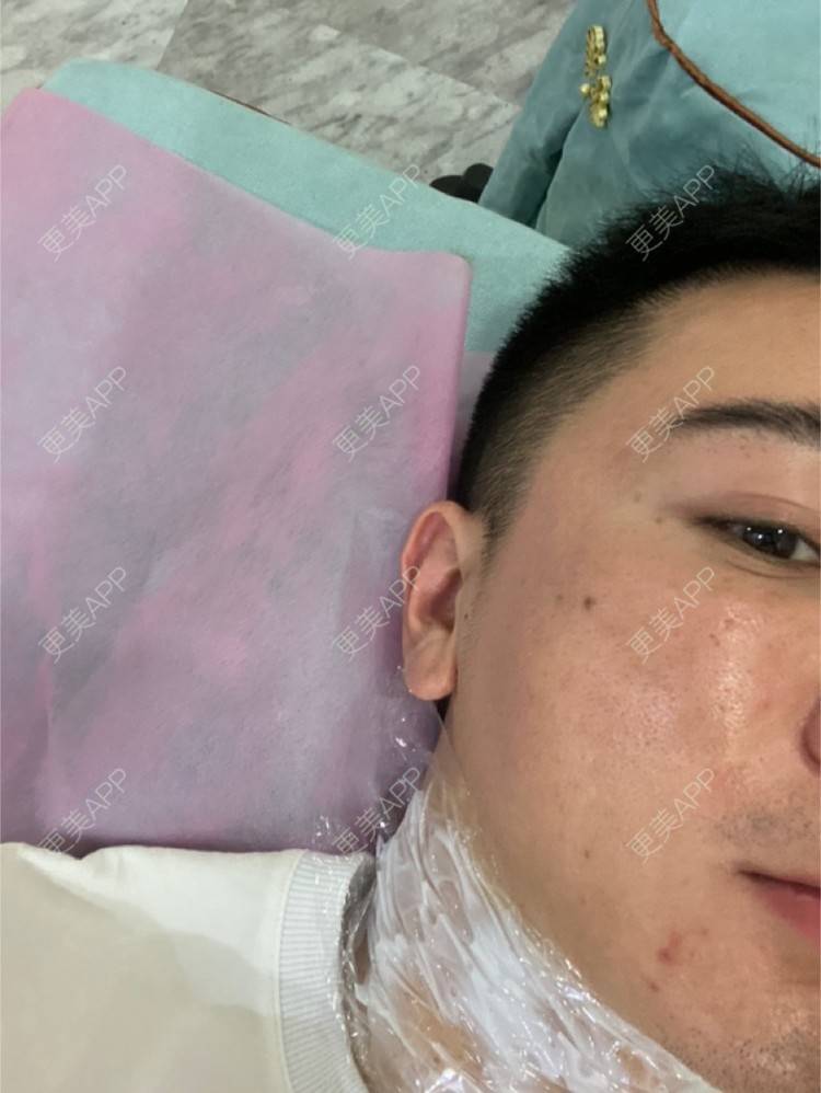 更美 - Es小喵的埋线提升经验 | 广州 | 埋线提升