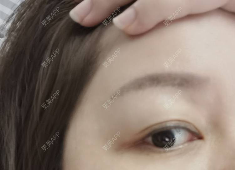 更美 - baoXbao的皮秒激光经验 | 皮秒激光