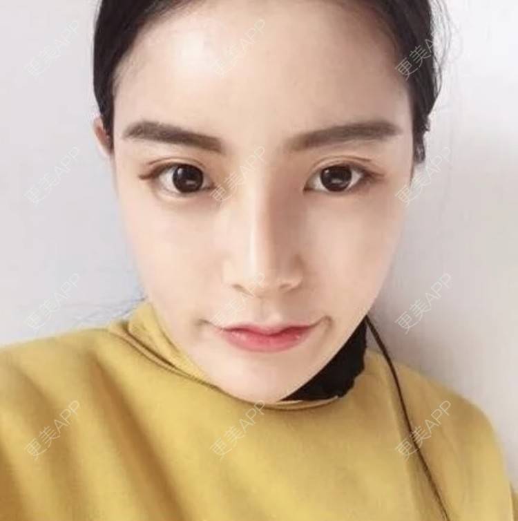 更美 - 妙药的埋线提升经验 | 埋线提升 | 南昌